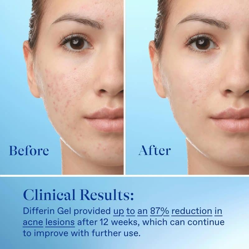 Differin Acne Treatment Gel - Image 29